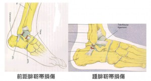 ankle_sprain2