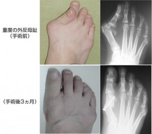 外反母趾 医療法人 西さっぽろ病院