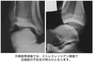 Ｃ足関節外側靭帯損傷追加写真
